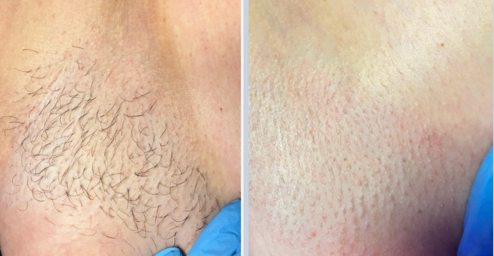Under Arm Wax