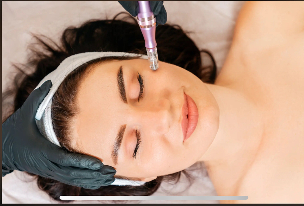 Microneedling Treatment