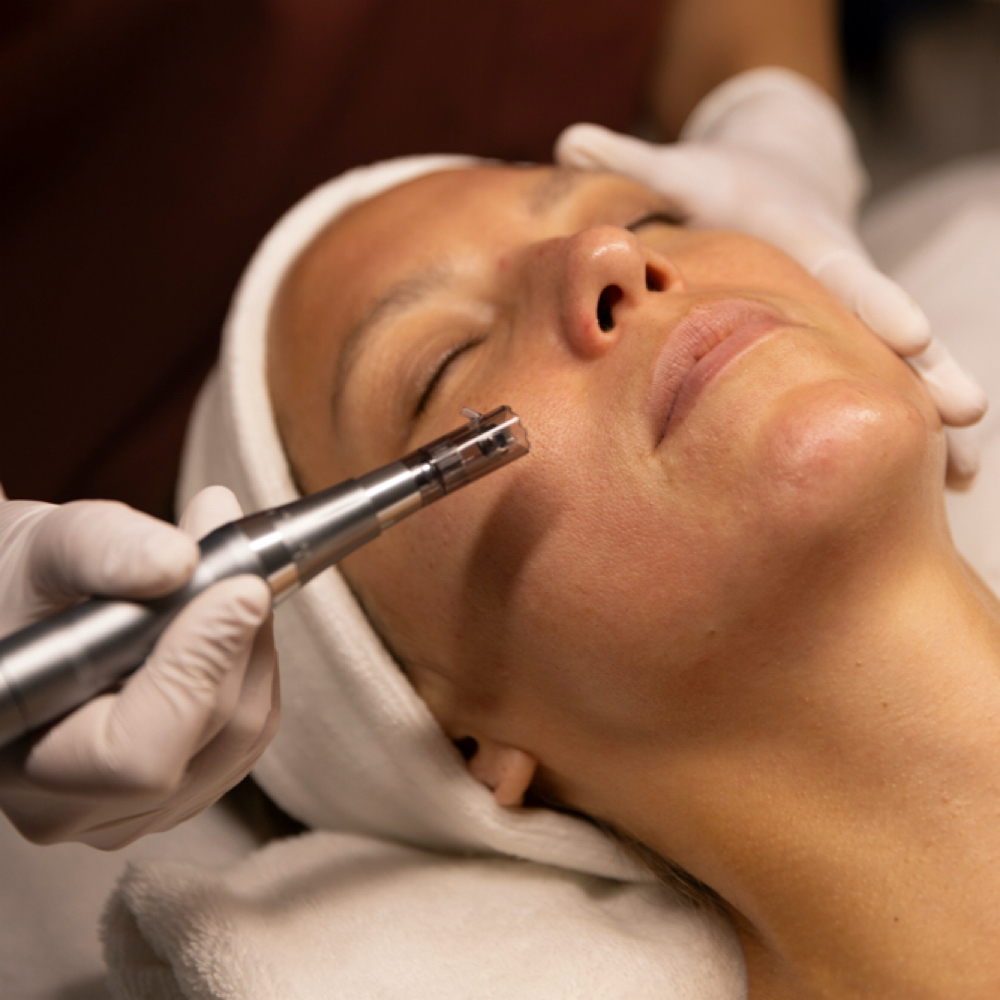 Microneedling Skin Renewal at Grace Esthetic in Buffalo Grove, IL