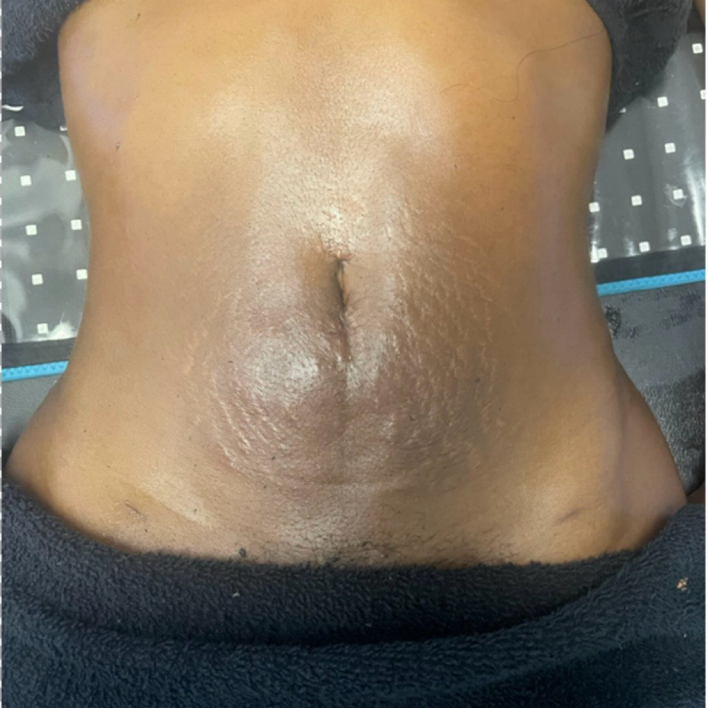 Lymphatic Massage Package #1 at Eunique Physiques | Post-Op Lymphatic Massage in Toledo, OH