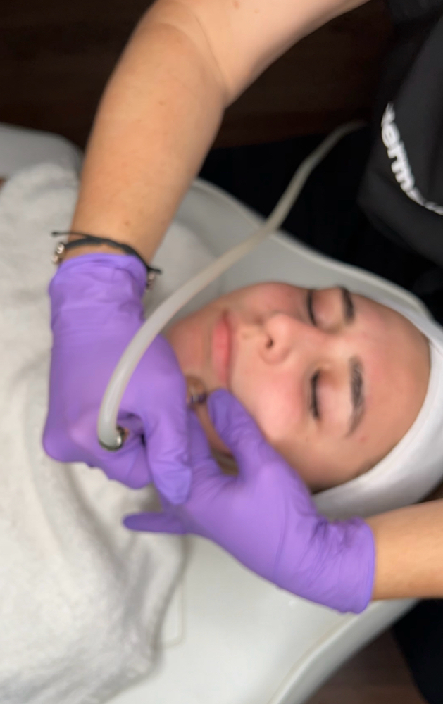 Microdermabrasion