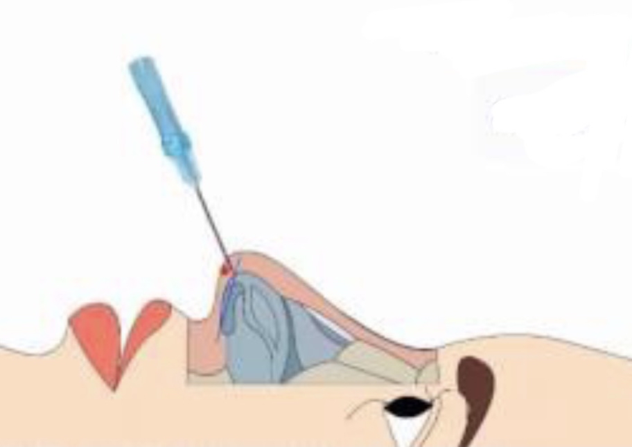 Non Surgical Nose Augmentation at Alchemy Med Spa in Houston, TX