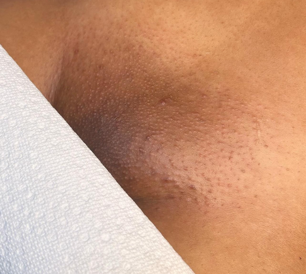 Brazilian Wax Retoque