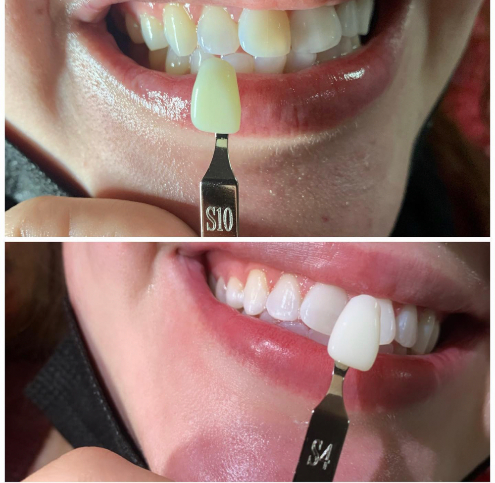 Teeth Whitening 40 Mins