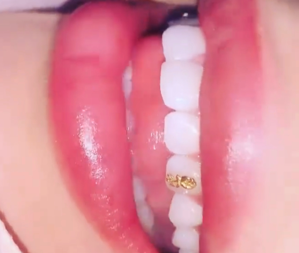 Gold Tooth Gem