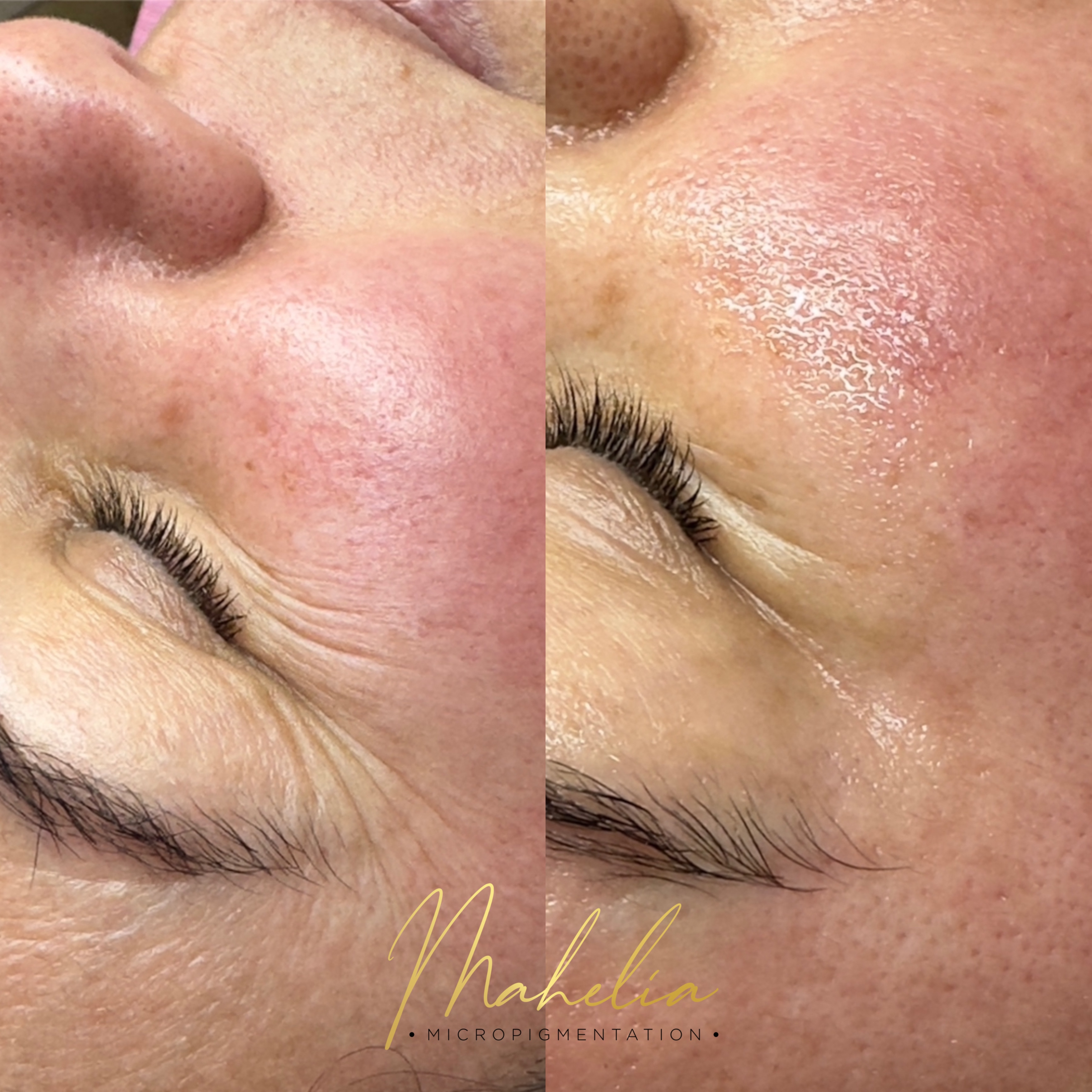 Microneedling at Mahelia PMU Academy in Whittier., CA