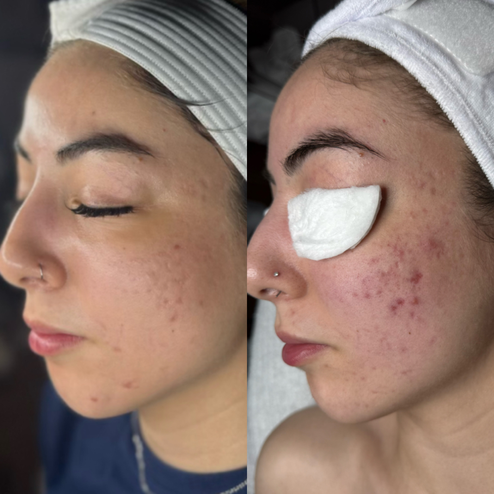 Acne Consultation + Treatment at Third Eye Esthetics in Pueblo, CO