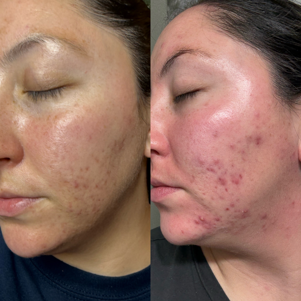 Acne Bootcamp Consult + Treatment at Third Eye Esthetics in Pueblo, CO