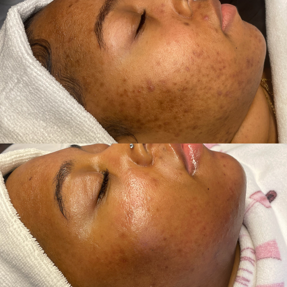 Lactic lightening Enhancement