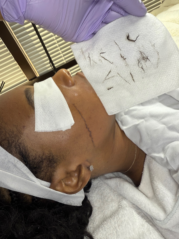 Dermaplane facial