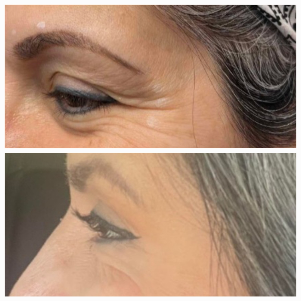 Crow's Feet (Botox)