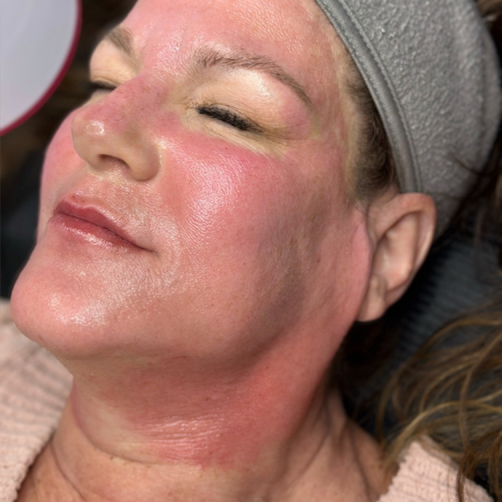 Microneedling Rev Facial at Revitalize Health in Florence, SC