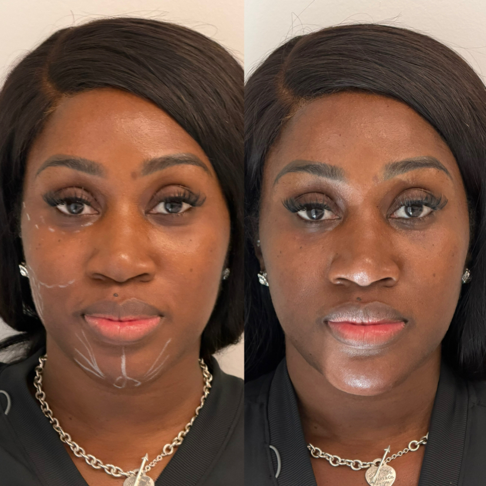 Sculptra at Atelier Aesthetics and Infusions in Dallas, TX