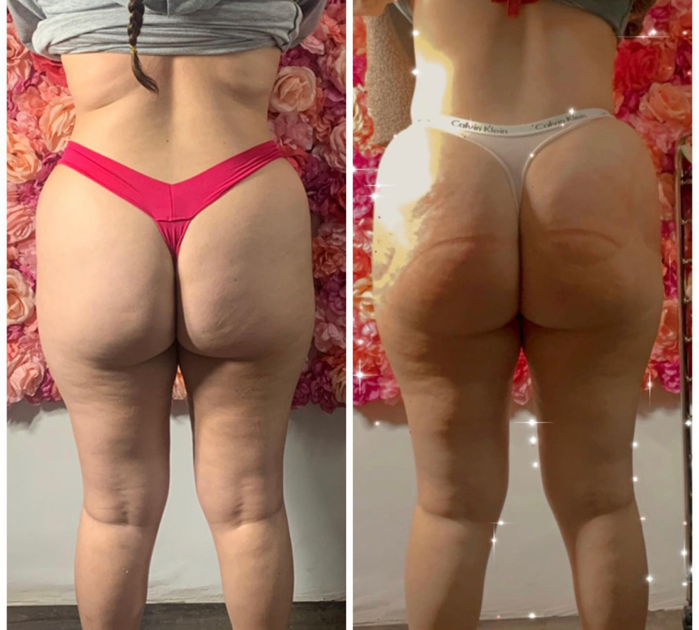 Non Invasive BBL(only)