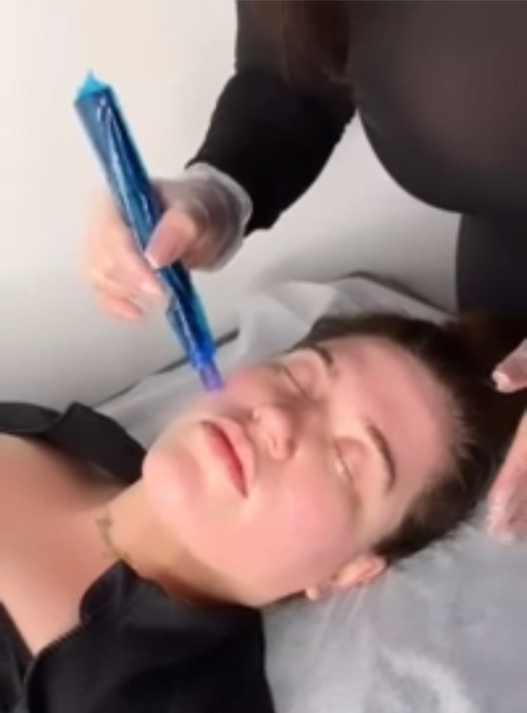 Microneedling Face