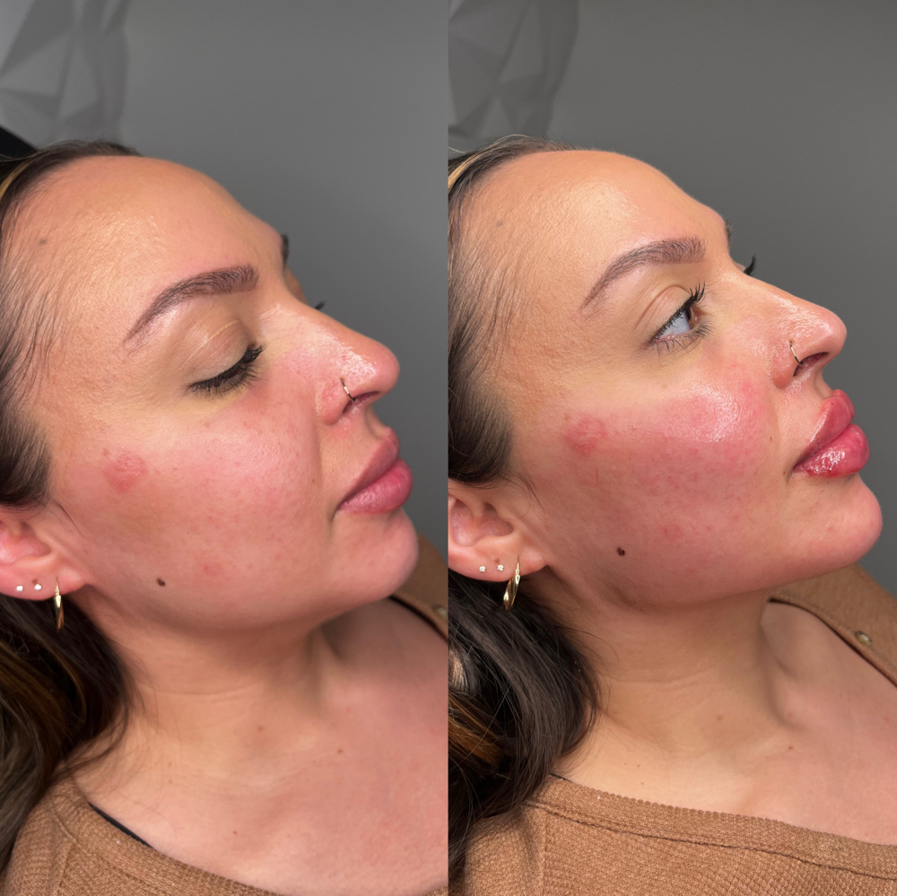 Jawline Contouring