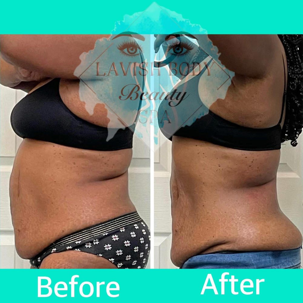 4 Cavitation & Laser Lipo 4 Ses.