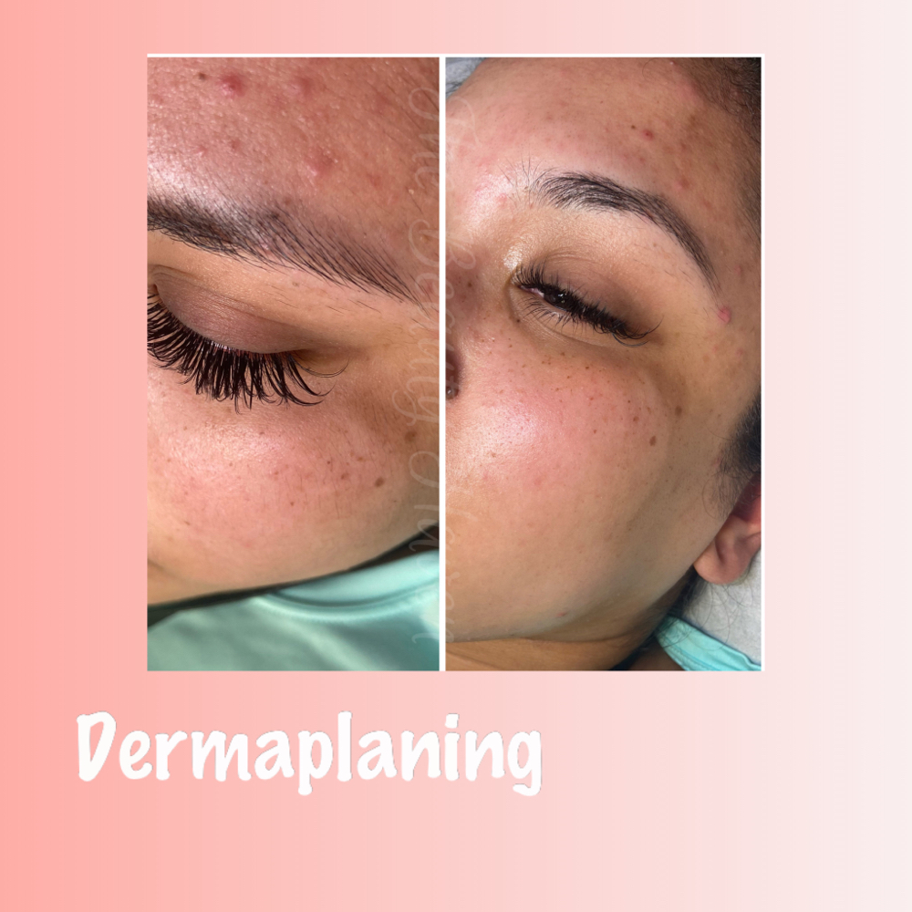 Dermaplaning