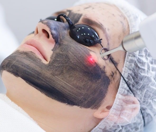 Carbon Laser Peel