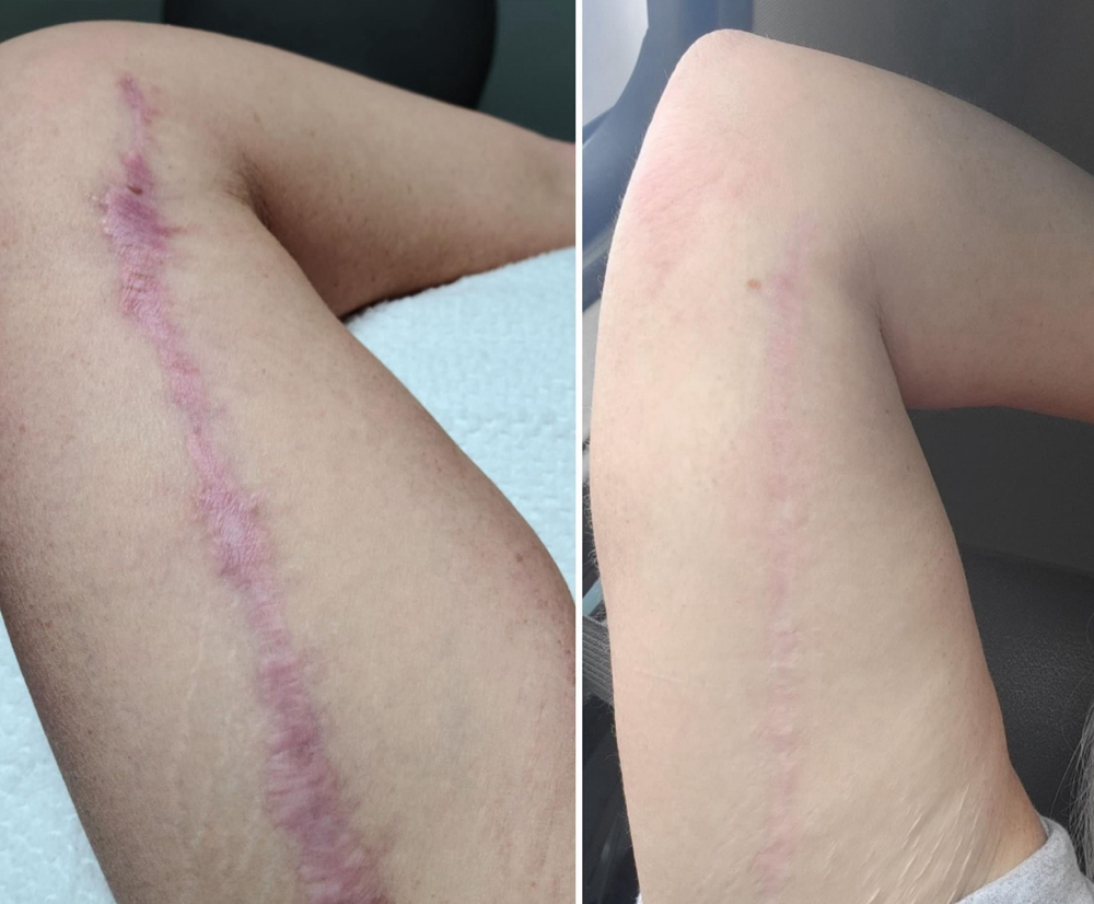 Scar Rejuvenation