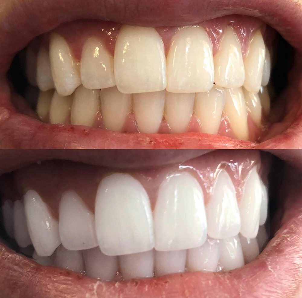 SunnaSmile Classic Teeth Whitening