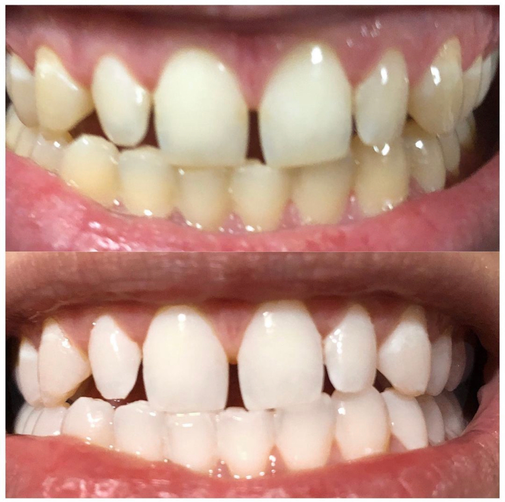 SunnaSmile SuperGel Teeth Whitening