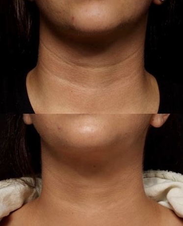 Neck Rejuvenation