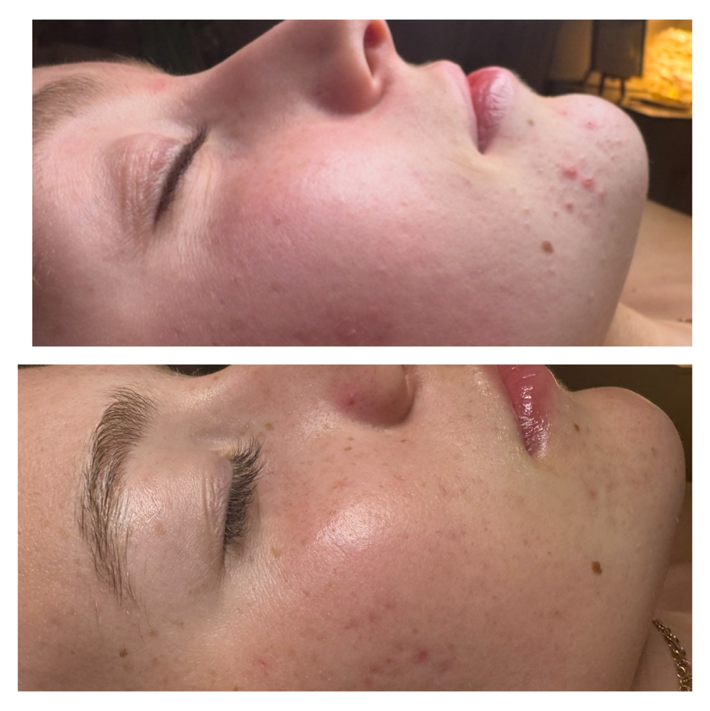 Face Reality Acne Maintence Peel