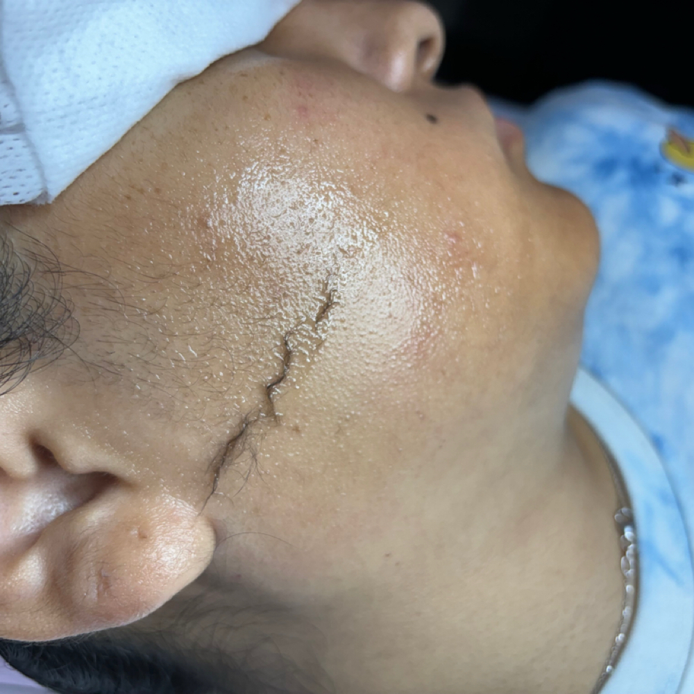 Glass Skin Dermaplane at Diamond Beauty Studio in Rialto, CA