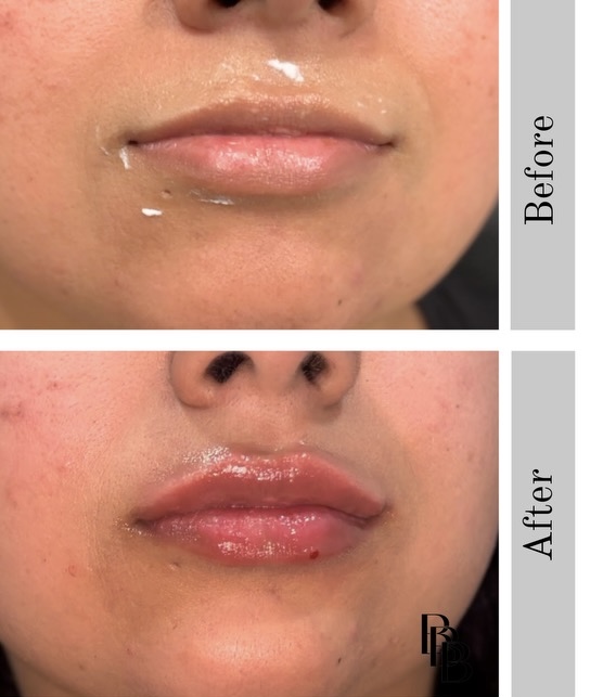 Full Lips