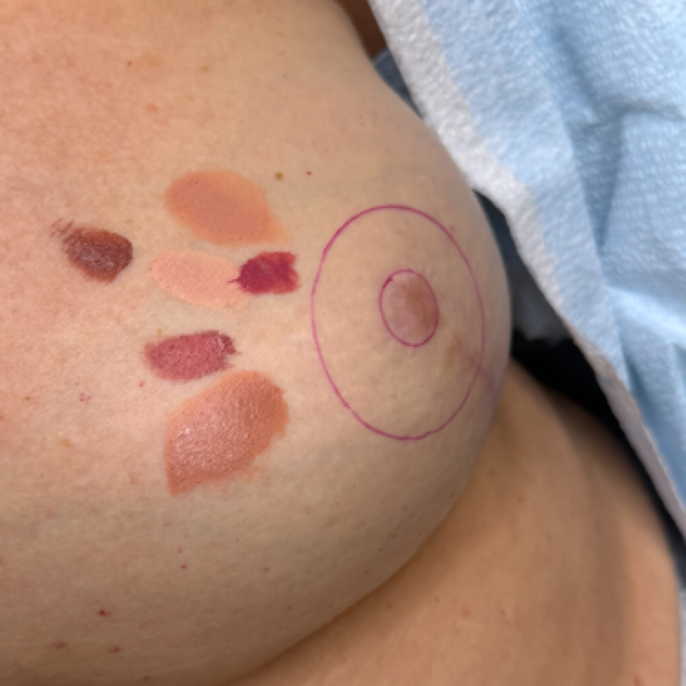 Areola Restoration Consult at Camouflaged in Cedar Park, TX
