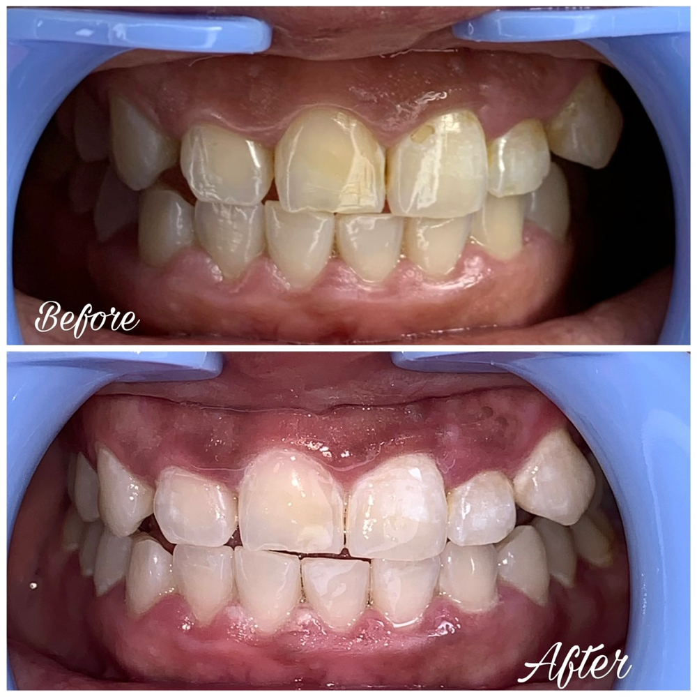 Teeth Whitening