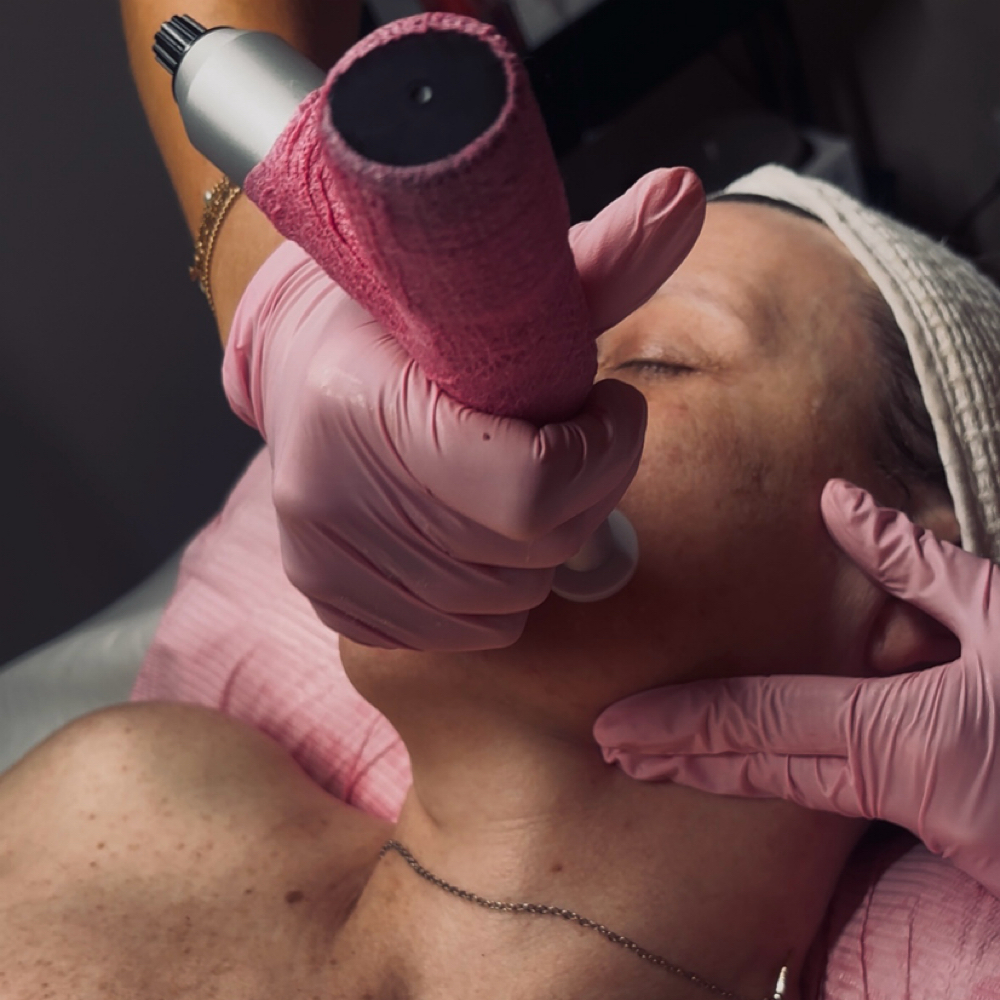 Procell Microchanneling at Radiant Glo Aesthetics in Ottawa, KS