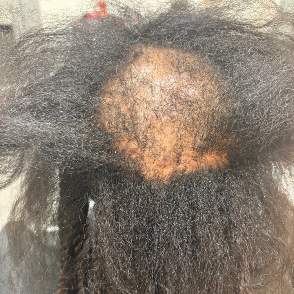 Alopecia & Thinning Hair Braiding C at Braids by Ami in Geneva Illinois, IL