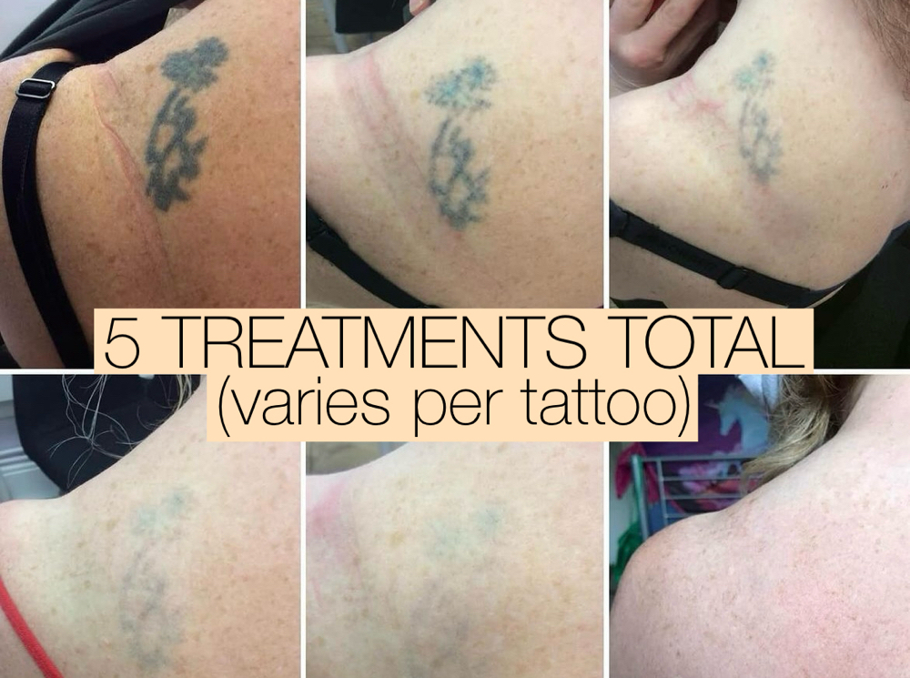 Non-Laser Tattoo Removal 1” Square