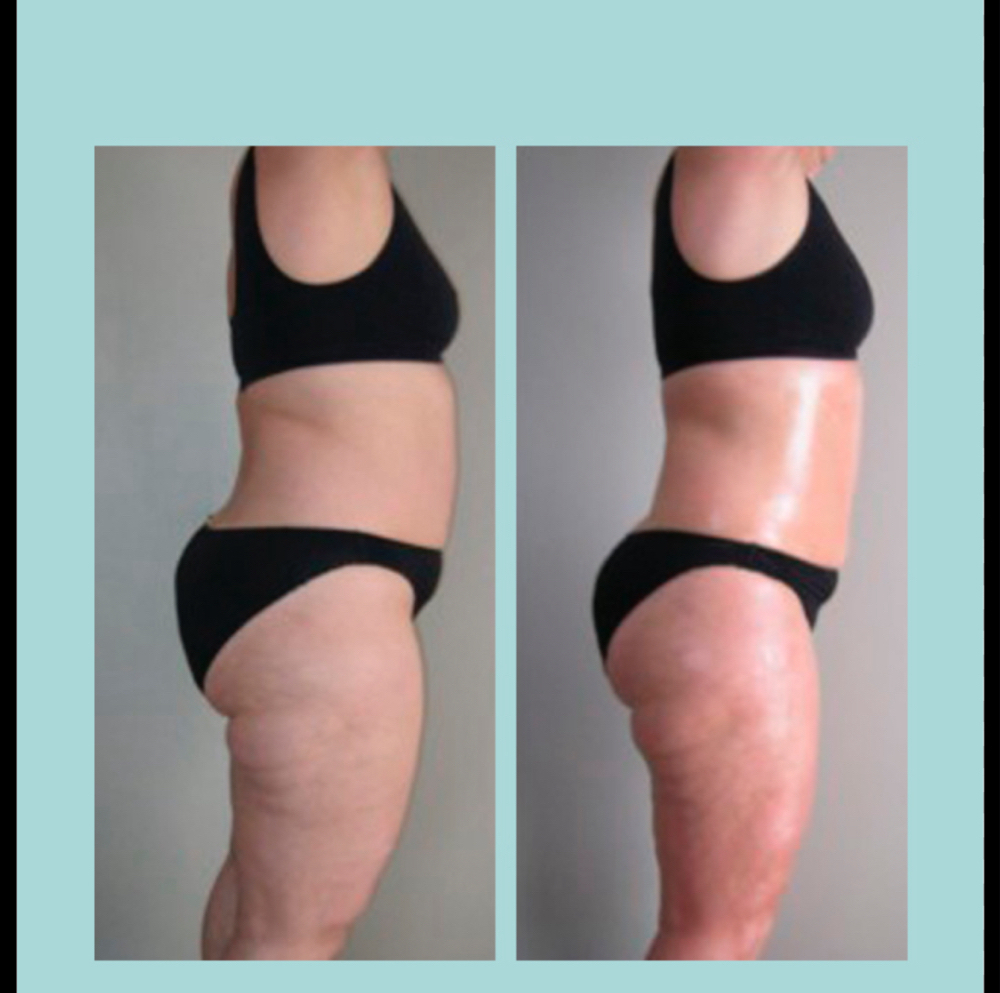 Body Contouring Wrap