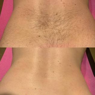 Lower back wax