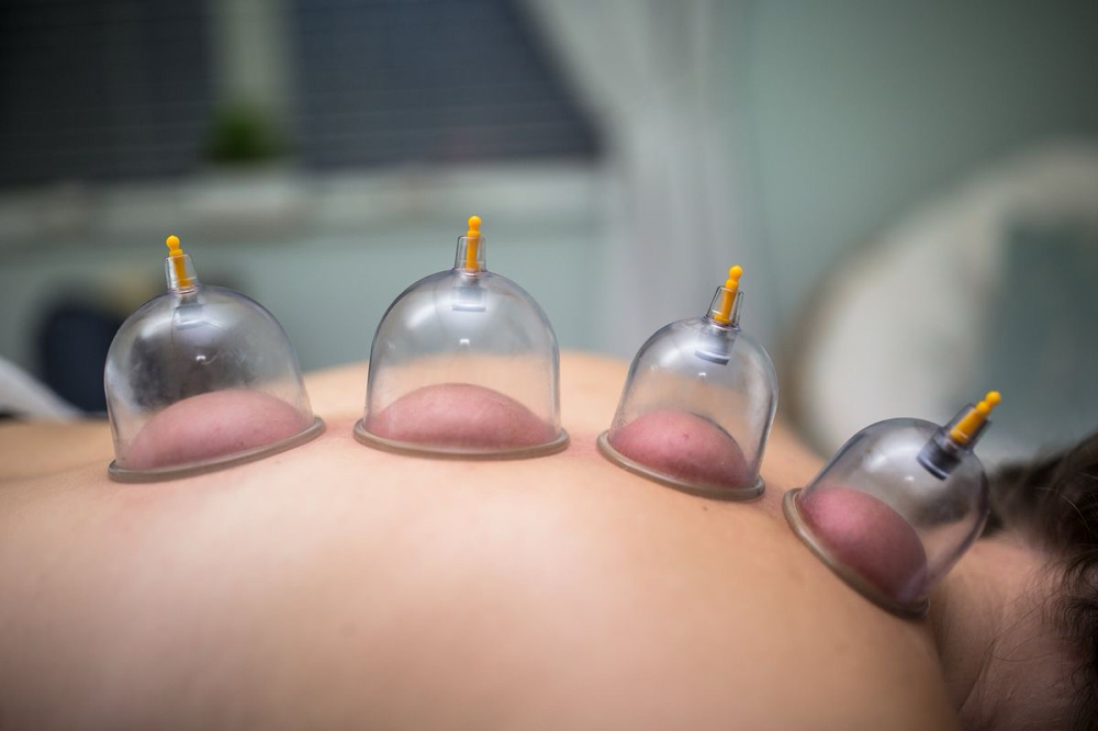 Cupping