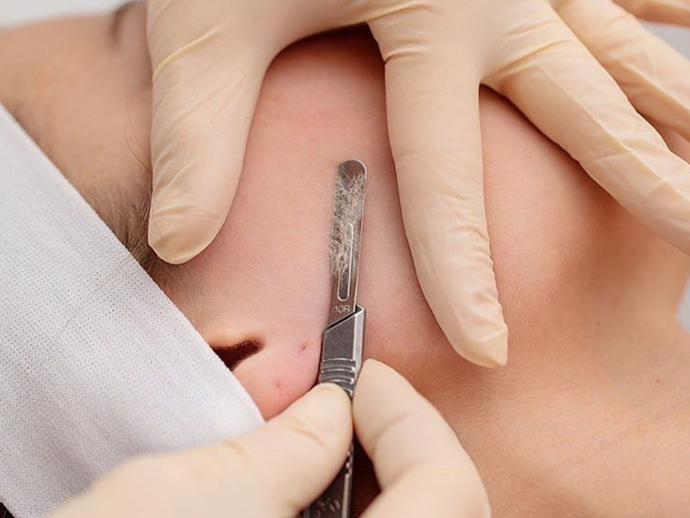 DERMAPLANE FACIAL at Golden Esthetics in Destrehan, LA