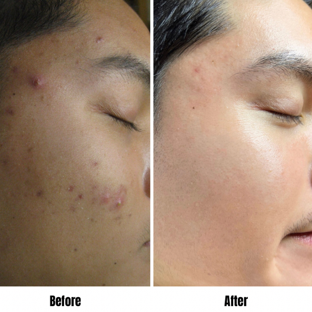 Acne Boot Camp Consultation at Good Skin Co. in Sarasota, FL