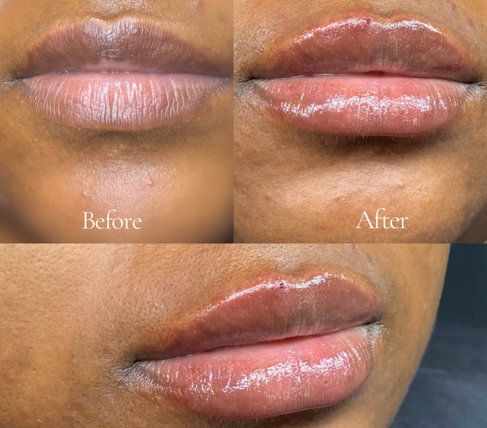 Lip Filler