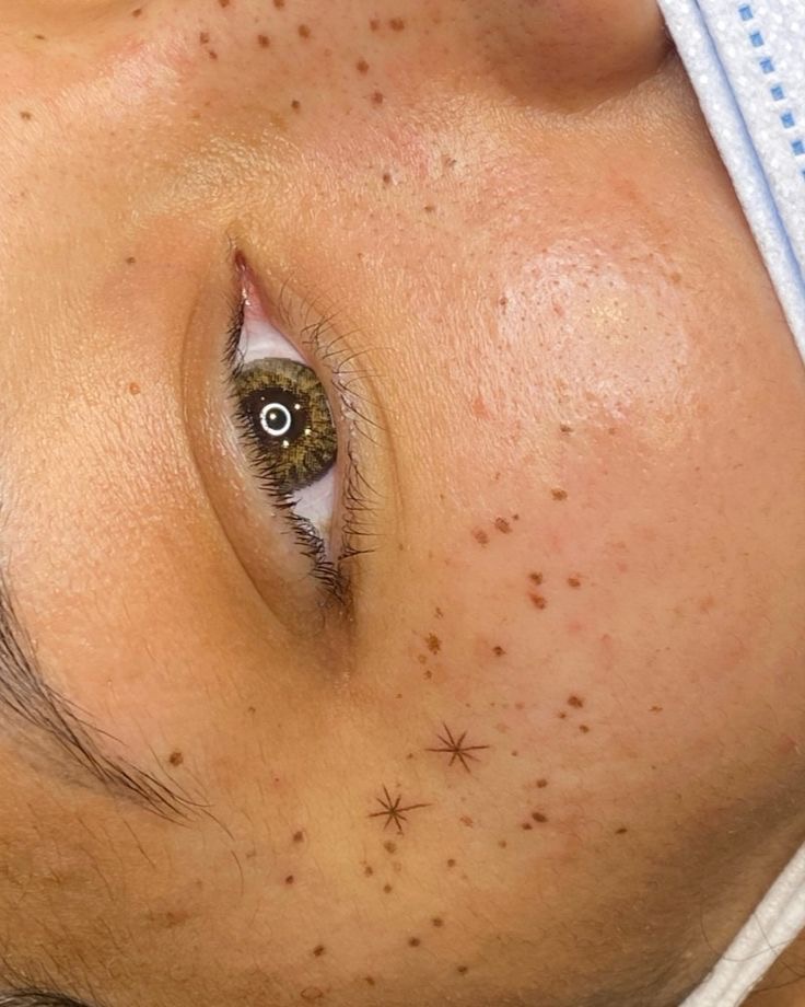 Scattered Freckles