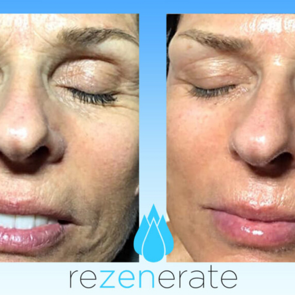 Rezenerate Full Face & Lip at Genie of Skin in Mooresville, NC
