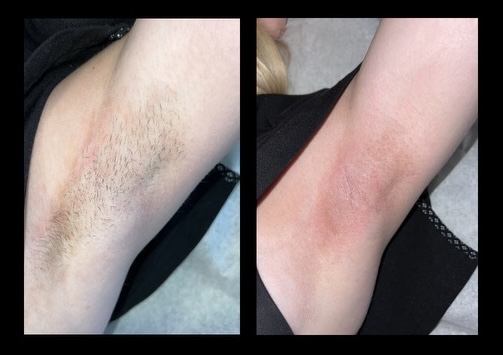 Underarms Wax