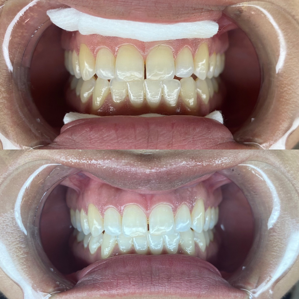 60 Minute Teeth Whitening at Madi-Lou's Studio in Austin, TX