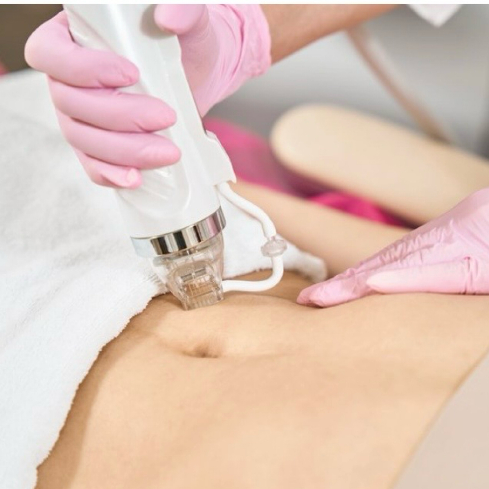 RF Microneedling Stomach at Luvlookbeautyspa @GlossGenius in Las Vegas, NV