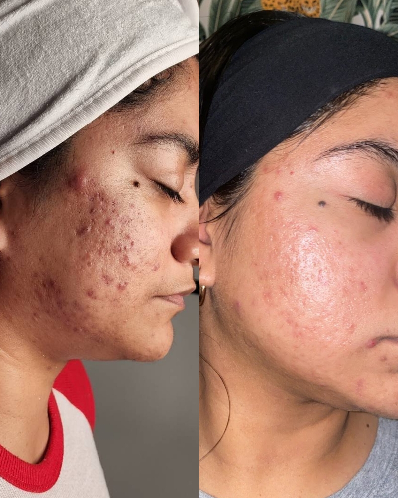Acne Rebuild Pro