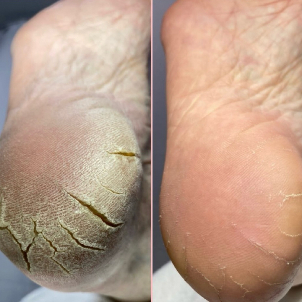 Callus Restoration at Southern Oregon PEDICURE CLINIC in Medford, OR
