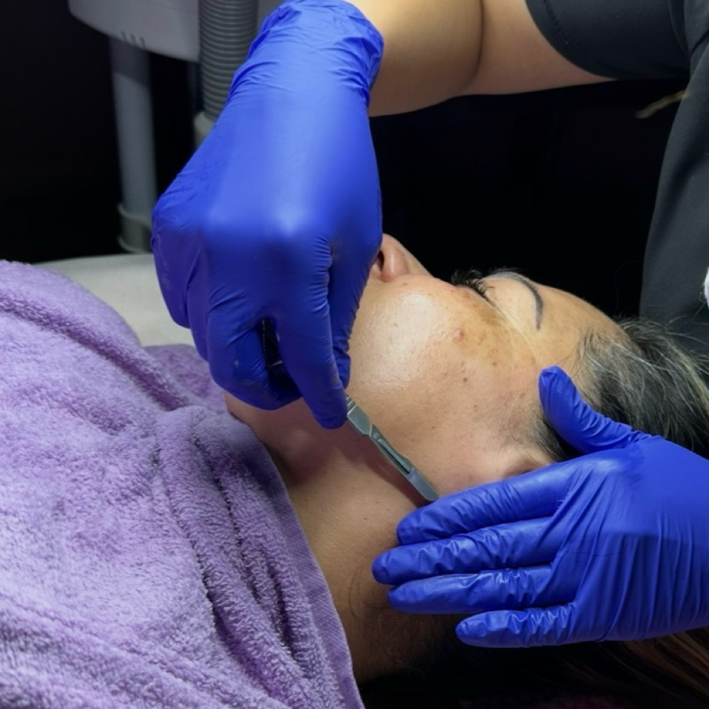 Dermaplaning Facial at Alejos Aesthetics in Cleveland, TX