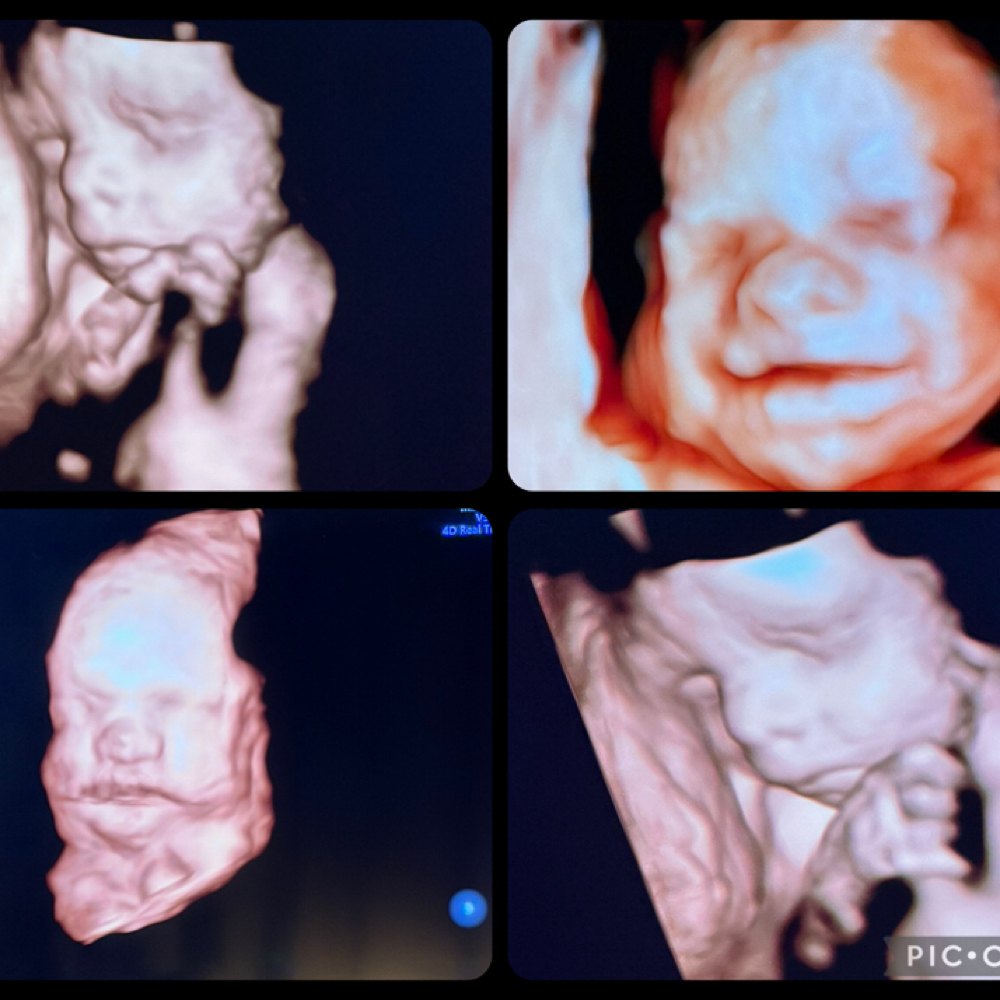 Extended 3D/4DScan (20-39 weeks) at Bump Studio  LLC in Rome, GA